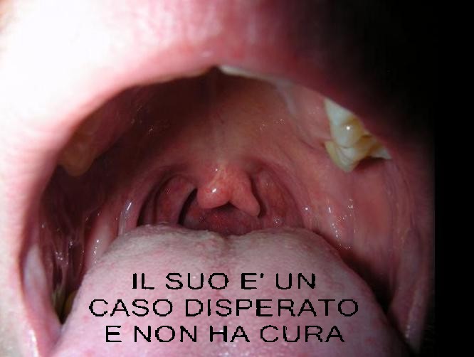 Bifid_uvula.JPG